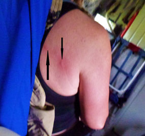 Angry Mosquito Bites!