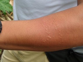 Effect of stinging nettle - 2 mins