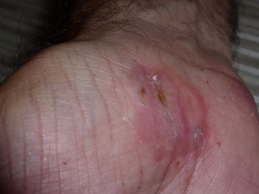 Nearly healed after three weeks