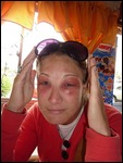 Allergic Reaction?