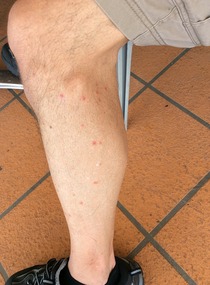 Vic's bites