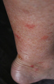 Day 2..Pam's Darwin midgie bites