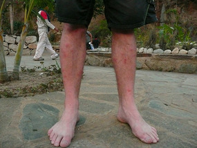 Cal's welted legs of sandfly bites